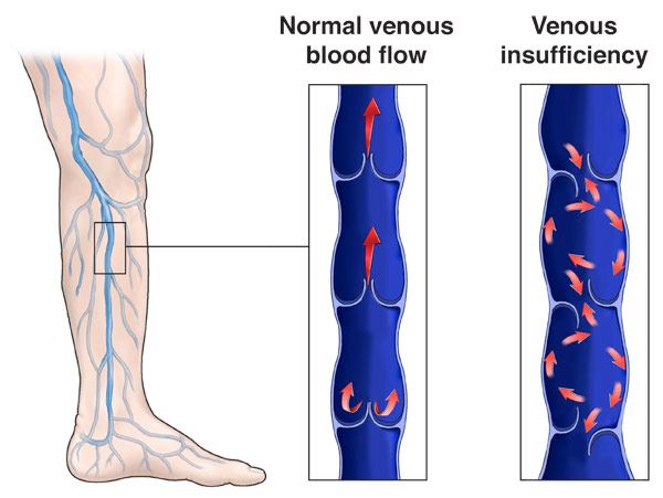 Diagram of healthy vs. damaged venous valves in CVI