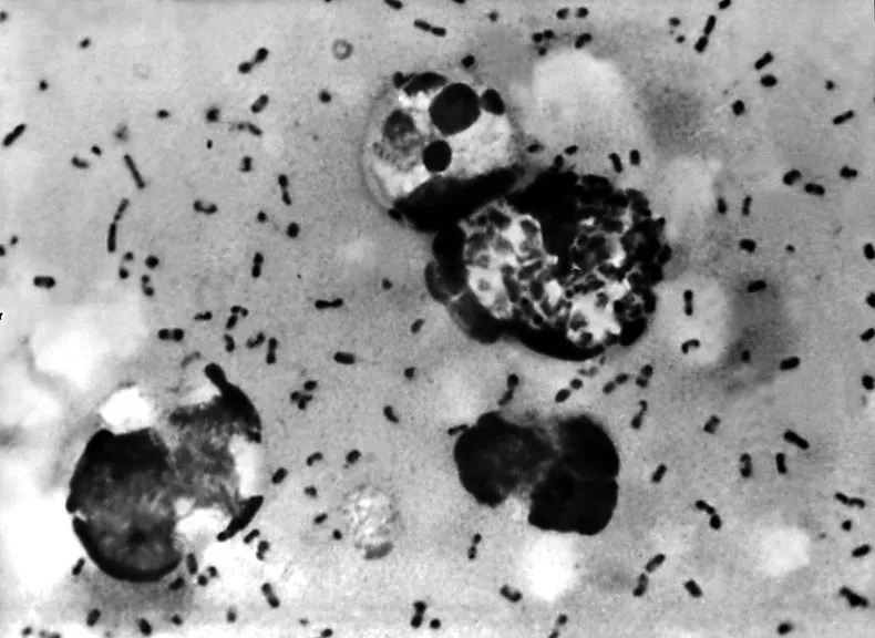 Lab microscope image of Yersinia pestis bacteria from bubonic plague patient's swollen lymph node, the infectious agent behind historic Black Death pandemics